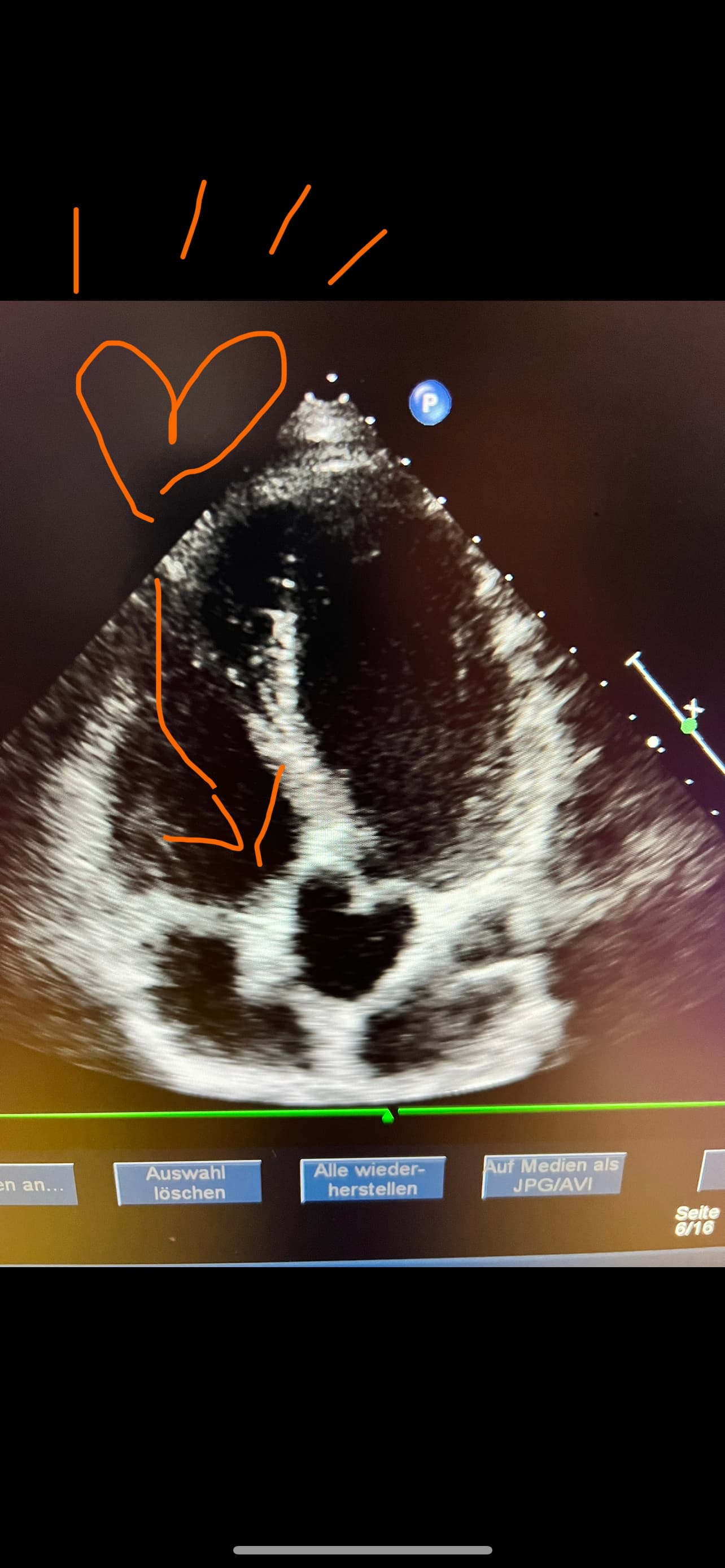 Gefäßultraschall - Halsschlagader